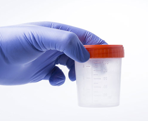 Frasco di plastica trasparente per campioni con tappo rosso tenuto da un guanto da laboratorio viola